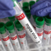 Health officials have confirmed the first US mpox case of a severe mpox strain in a person with no recent travel history. The case was identified in a Long Beach resident Read for moer information