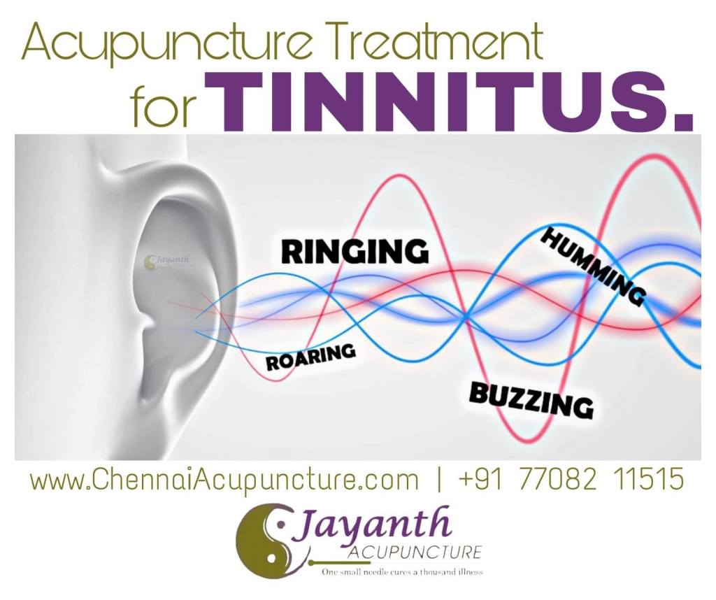Acupuncture treatment for Tinnitus in Chennai without any medication and side effects. Jay...