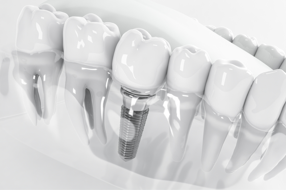 At Dentalist, we offer high-quality Dental Implants in Kuala Lumpur, Malaysia. Explore th...