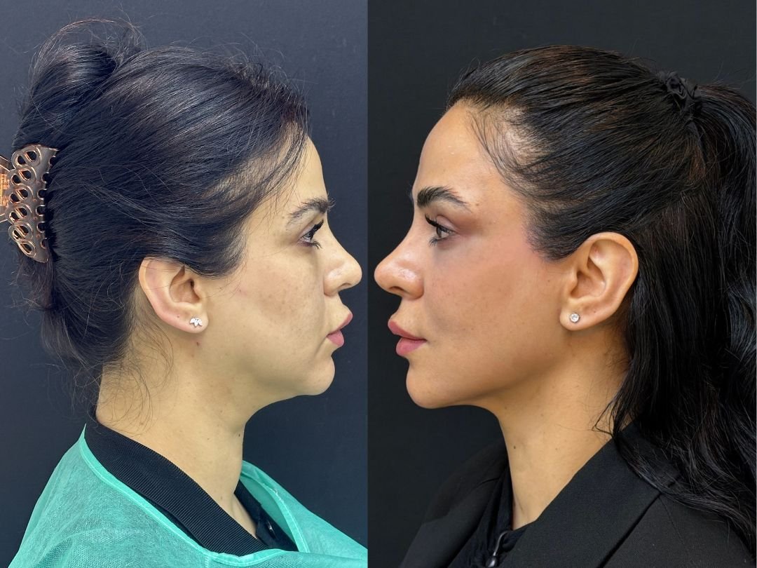Get advanced Endolift laser treatment in Dubai for skin tightening, fat reduction and faci...