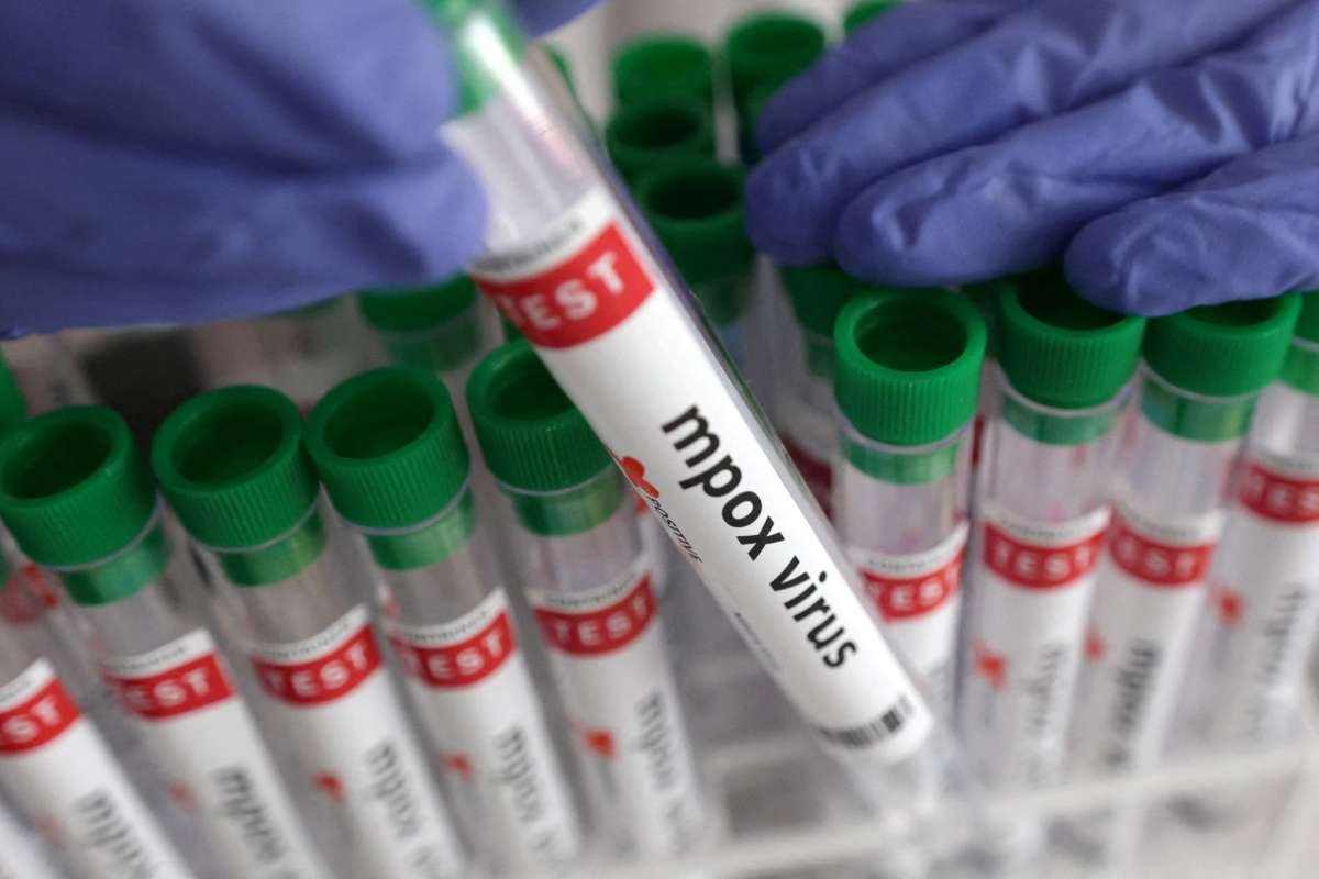 Health officials have confirmed the first US mpox case of a severe mpox strain in a person...
