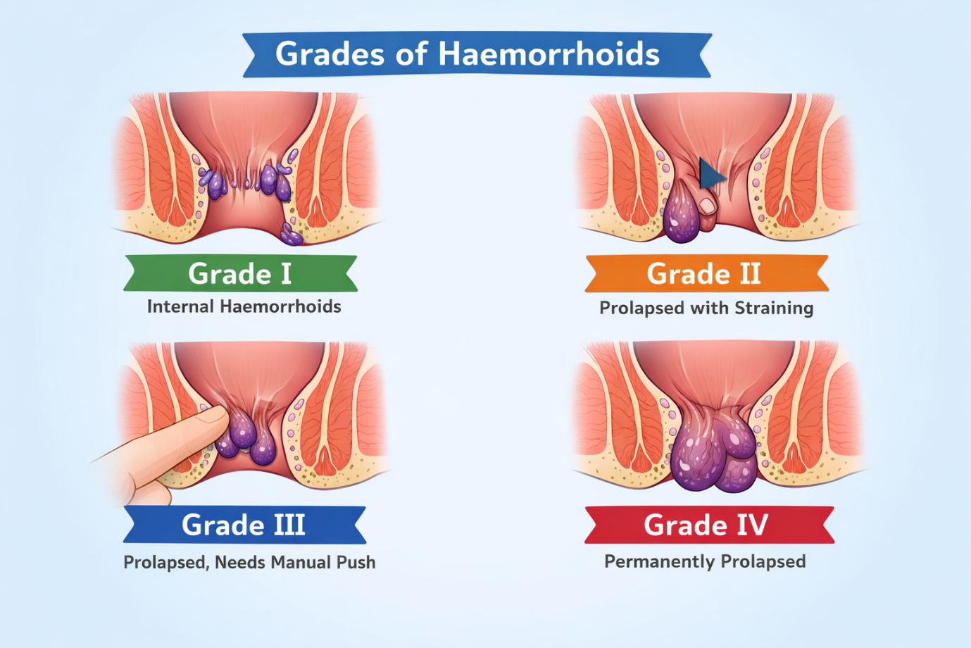 Joshua Franklyn MS FRCS offers expert assessment and treatment for haemorrhoids (piles), h...