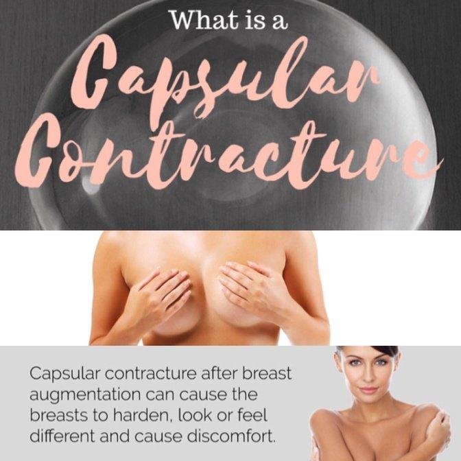 Modern treatment approaches for capsular contracture breast implants focus on reducing sca...